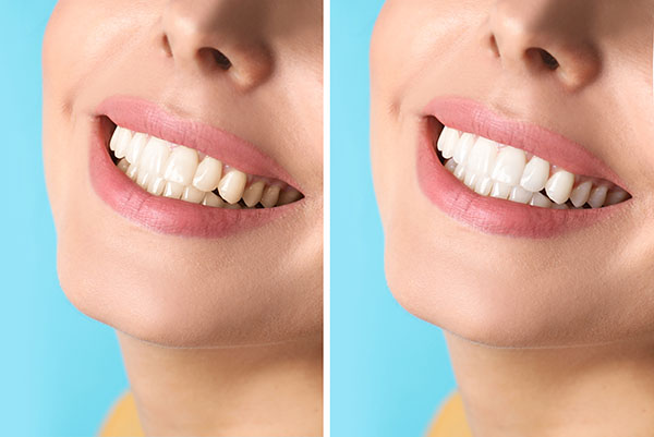 Cosmetic Dental Services With Natural Tooth Color from Mitra H. Bral, DDS in West Hollywood, CA
