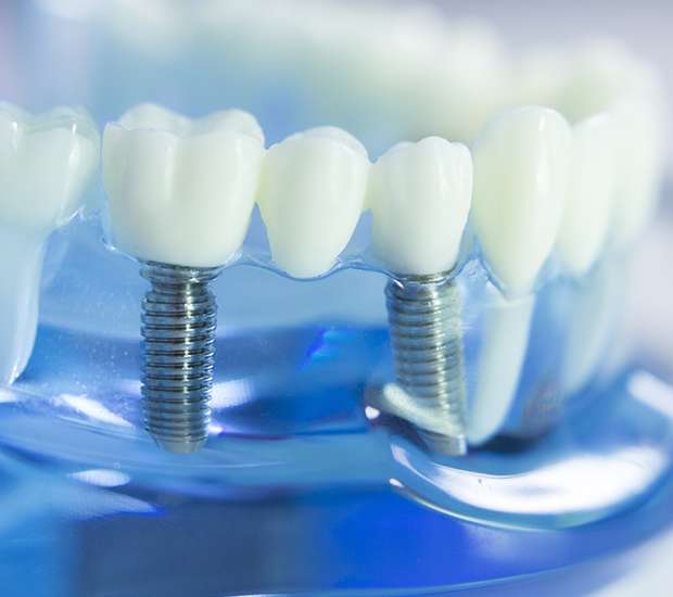 West Hollywood Dental Implants