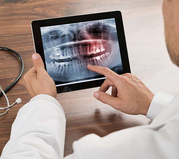 West Hollywood Types of Dental Root Fractures
