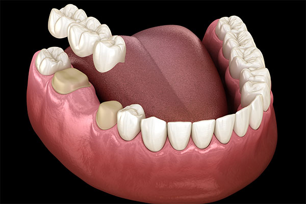 Are Dental Bridges Considered Cosmetic?